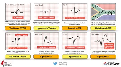 ekg readings abnormal|abnormal ekg examples.
